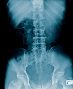 Osteoporosis Treatment at sunridge medical