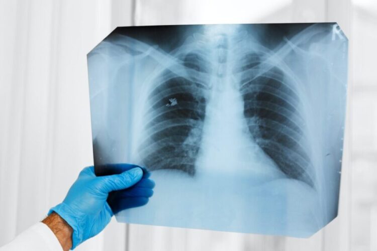 Alternative Lung Cancer Treatment at Sunridge Medical