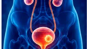 Alternative bladder cancer treatment and urinary system illustration at Sunridge Medical