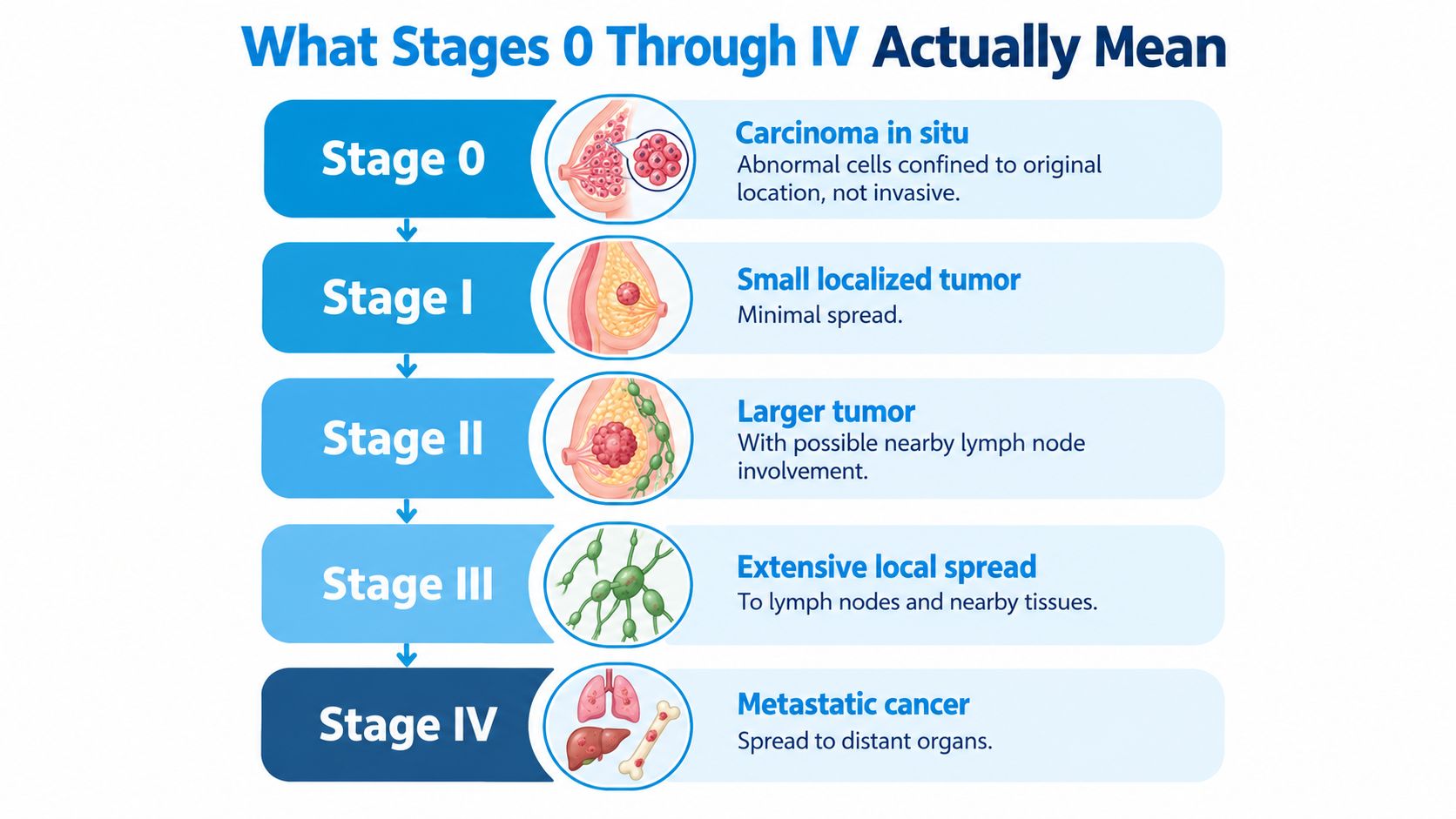 An infographic showing breast cancer progression from Stage 0 to Stage IV, detailing tumor growth and spread.